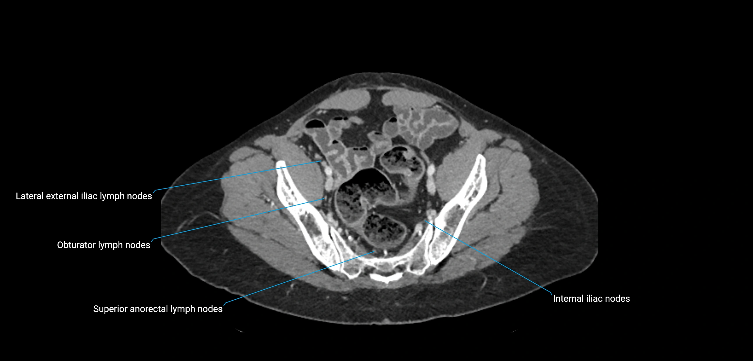 CT ct abdominal lymph nodes  axial cross sectional anatomy  enchanced radiology image -img-00002-00348.webp